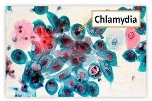 Bệnh chlamydia và những điều cần biết